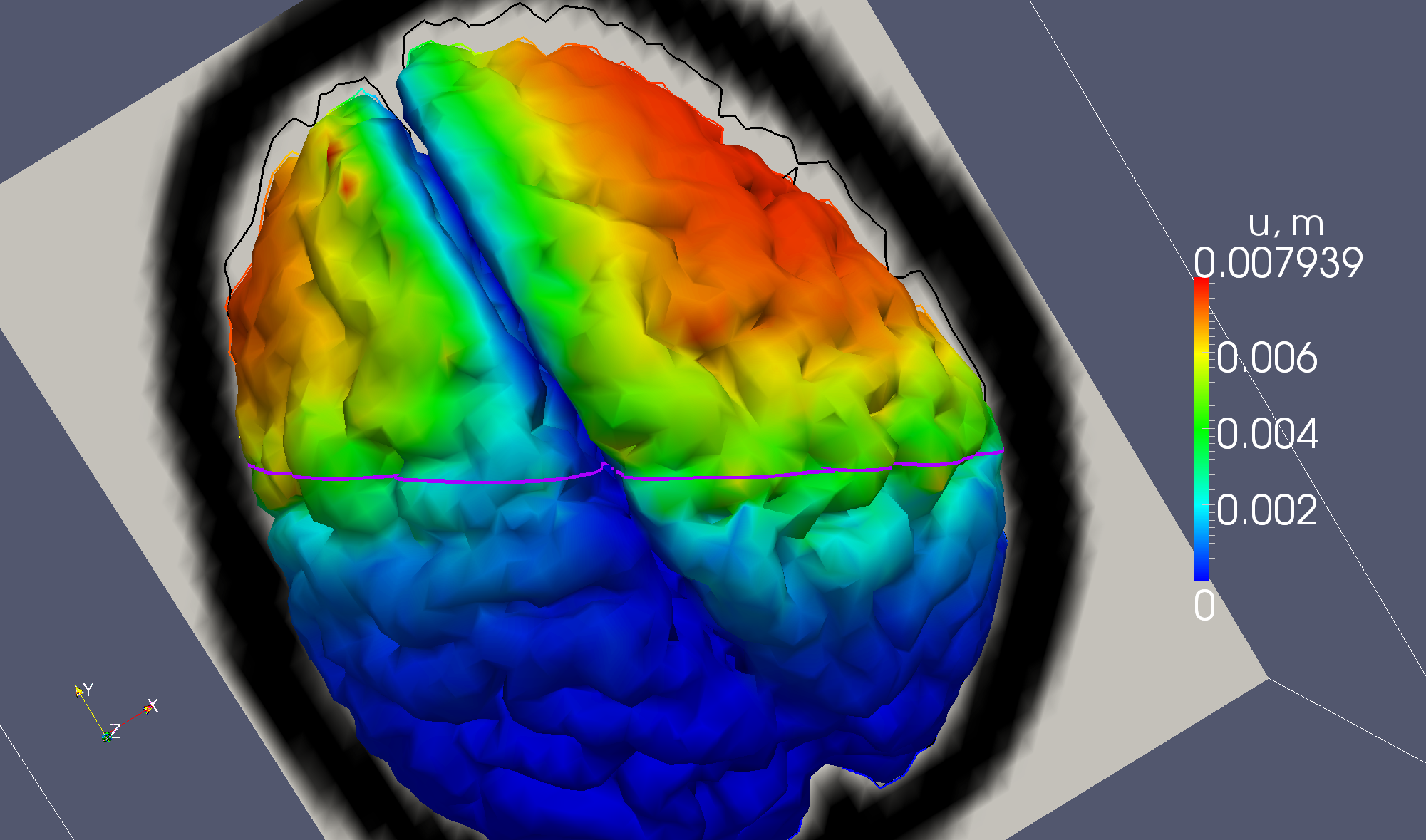 Brain deformation simulation